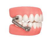 Аппарат Френкеля