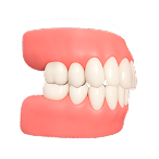 Исправление глубокого прикуса