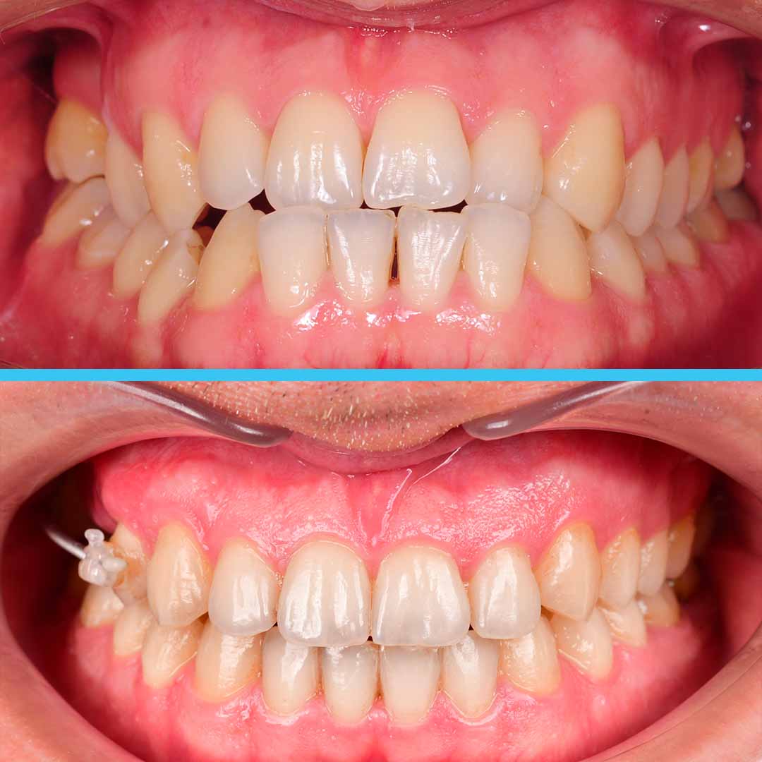 Коррекция мезиального прикуса и создание места для протезирования в области зубов 1.6 и 1.5