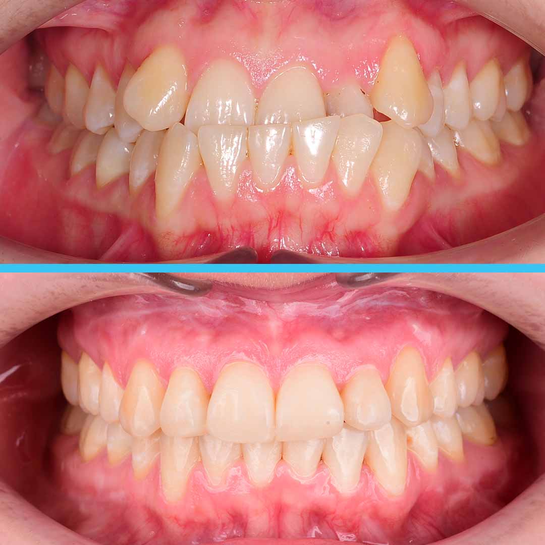 Коррекция мезиального прикуса с ЧЛХ