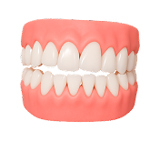 Лечение перекрестного прикуса