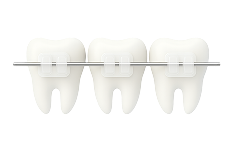 Эстетические брекеты