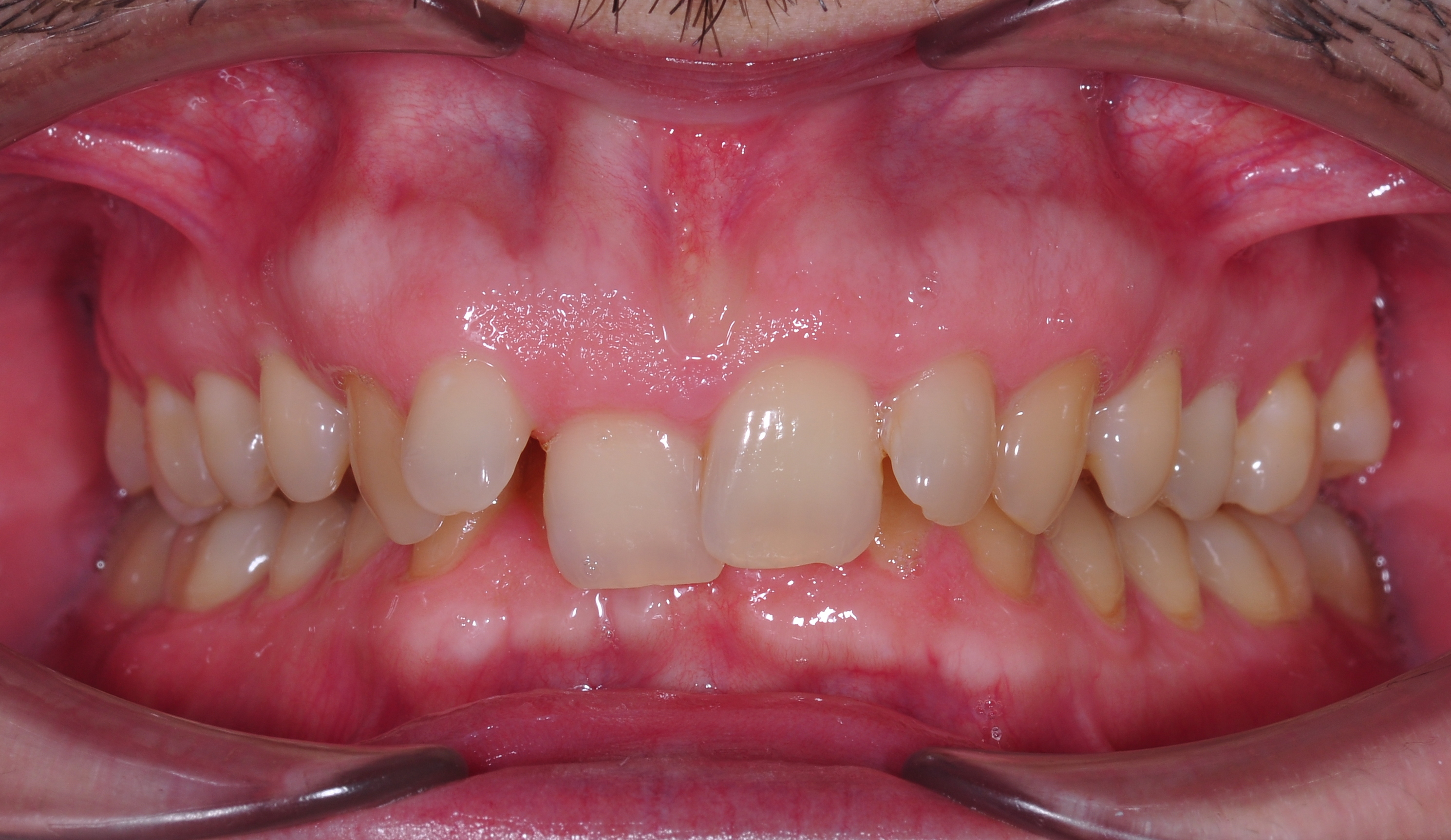 ЛЕЧЕНИЕ ПЕРЕКРЕСТНОГО ПРИКУСА, УСТРАНЕНИЕ СКУЧЕННОСТИ ЗУБОВ. 