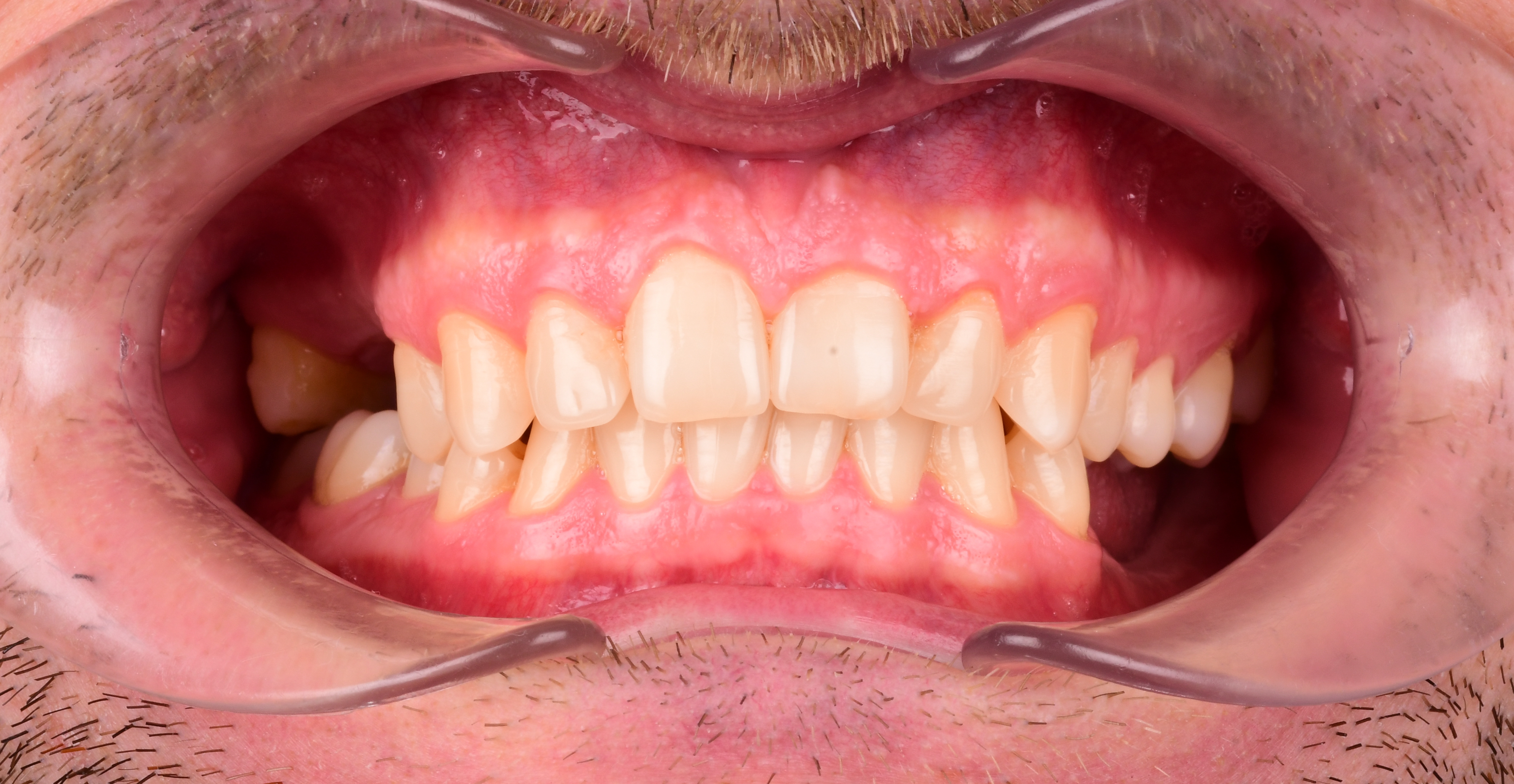 ЛЕЧЕНИЕ ПЕРЕКРЕСТНОГО ПРИКУСА, УСТРАНЕНИЕ СКУЧЕННОСТИ ЗУБОВ. 