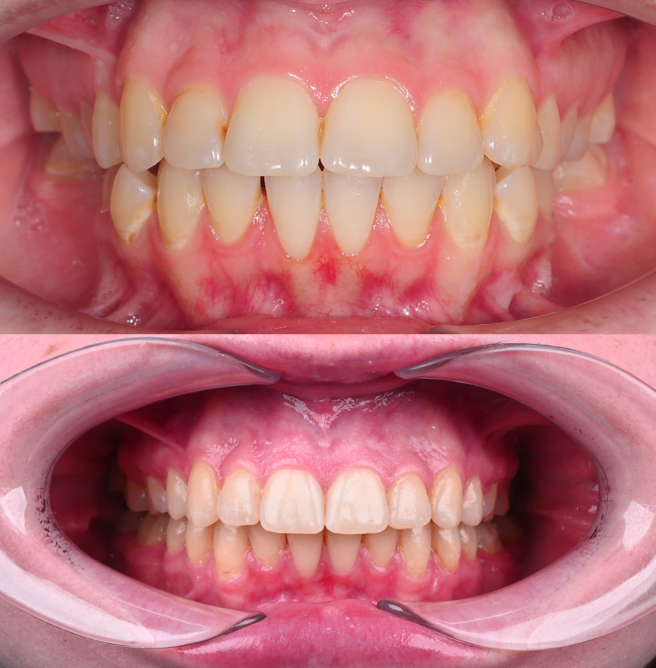 Коррекция мезиального прикуса и скелетной асимметрии с применением ЧЛХ