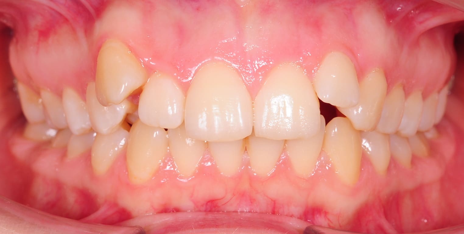 ЛЕЧЕНИЕ ПЕРЕКРЕСТНОГО ПРИКУСА, УСТРАНЕНИЕ СКУЧЕННОСТИ ЗУБОВ. 