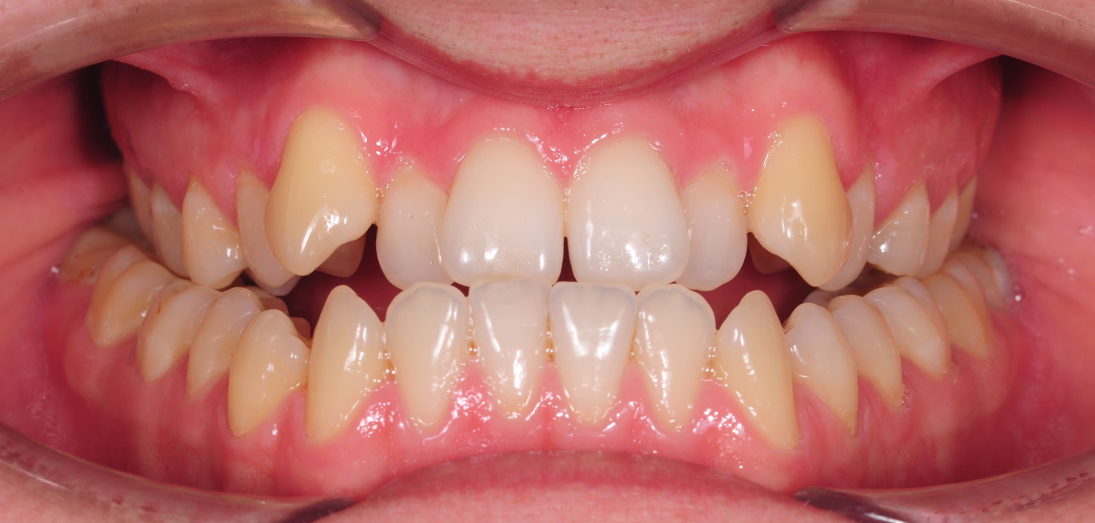 ЛЕЧЕНИЕ ПЕРЕКРЕСТНОГО ПРИКУСА, УСТРАНЕНИЕ СКУЧЕННОСТИ ЗУБОВ. 