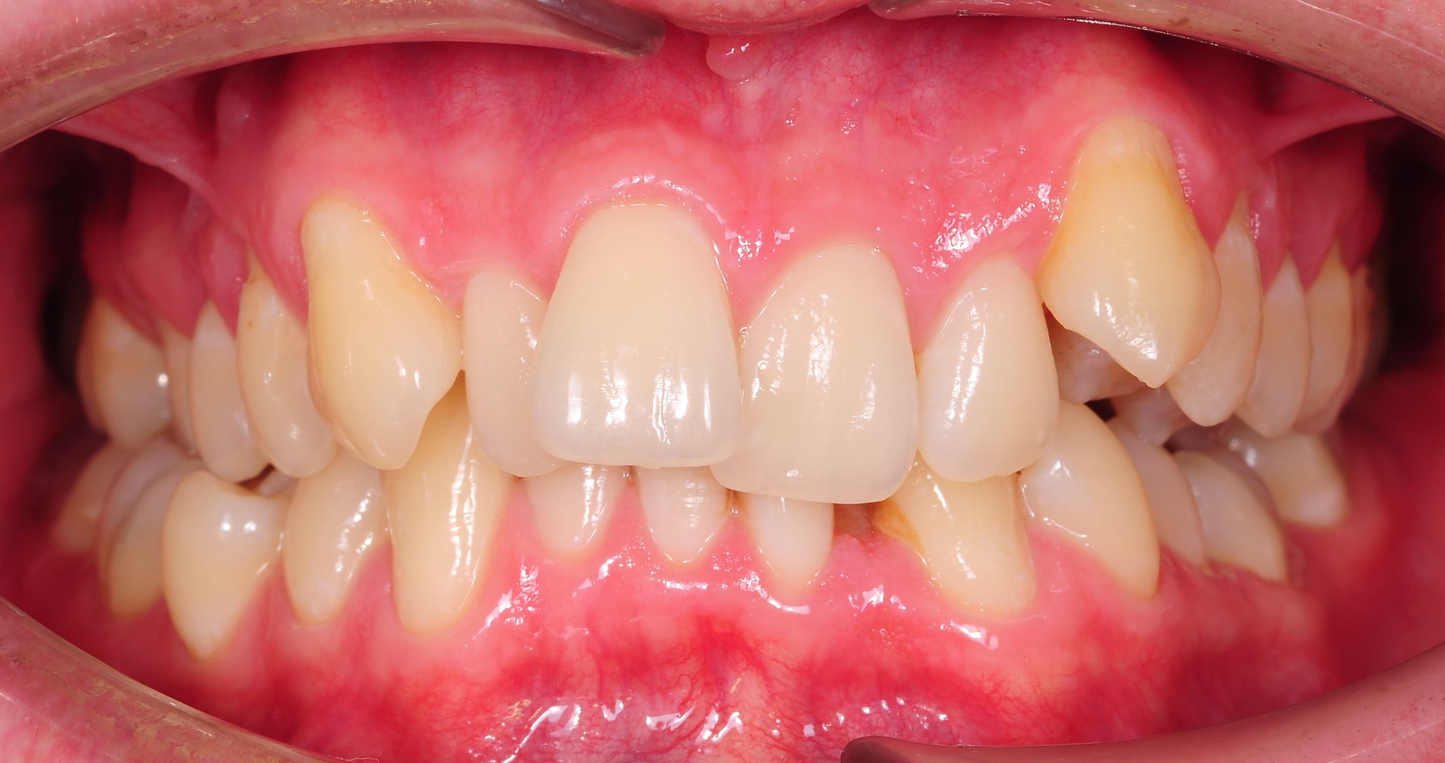 ЛЕЧЕНИЕ ПЕРЕКРЕСТНОГО ПРИКУСА, УСТРАНЕНИЕ СКУЧЕННОСТИ ЗУБОВ. 