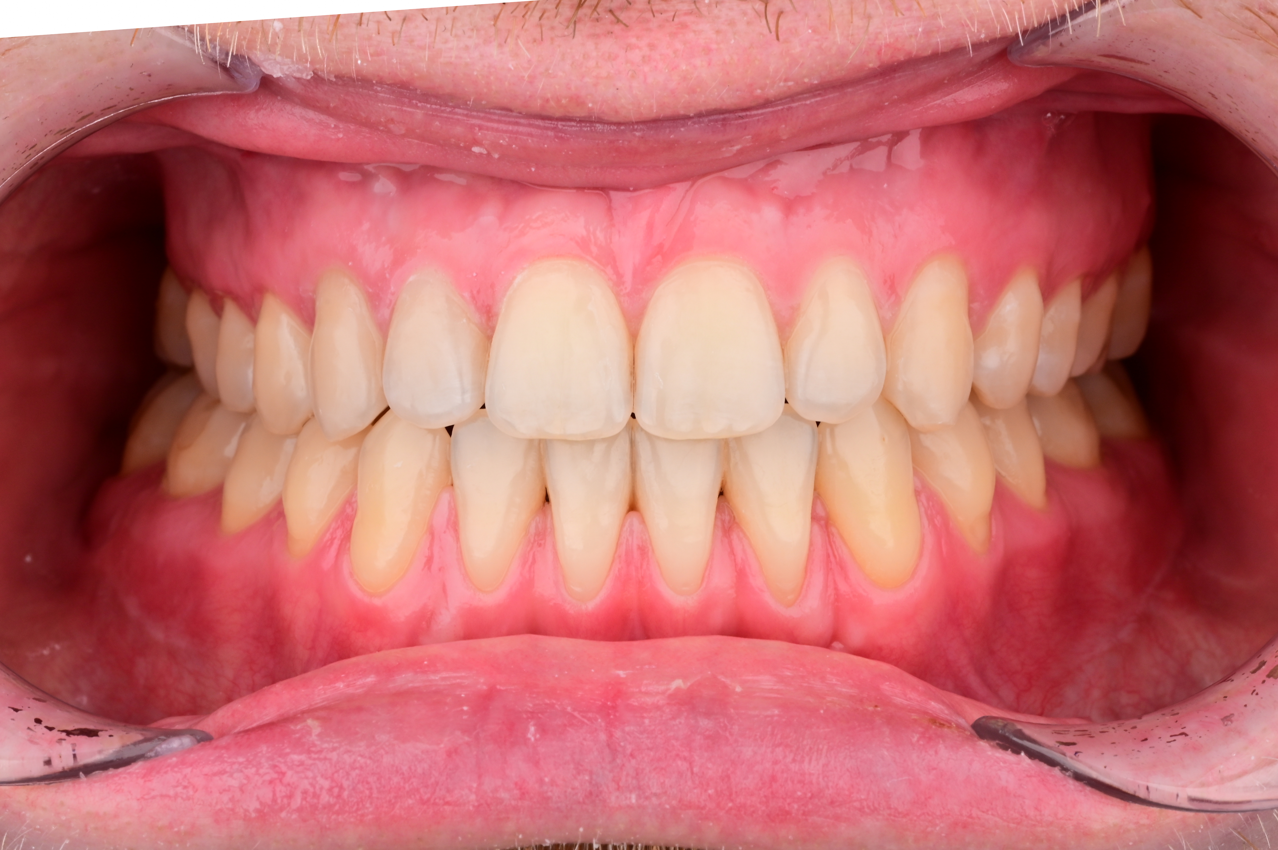 ЛЕЧЕНИЕ ПЕРЕКРЕСТНОГО ПРИКУСА, УСТРАНЕНИЕ СКУЧЕННОСТИ ЗУБОВ. 