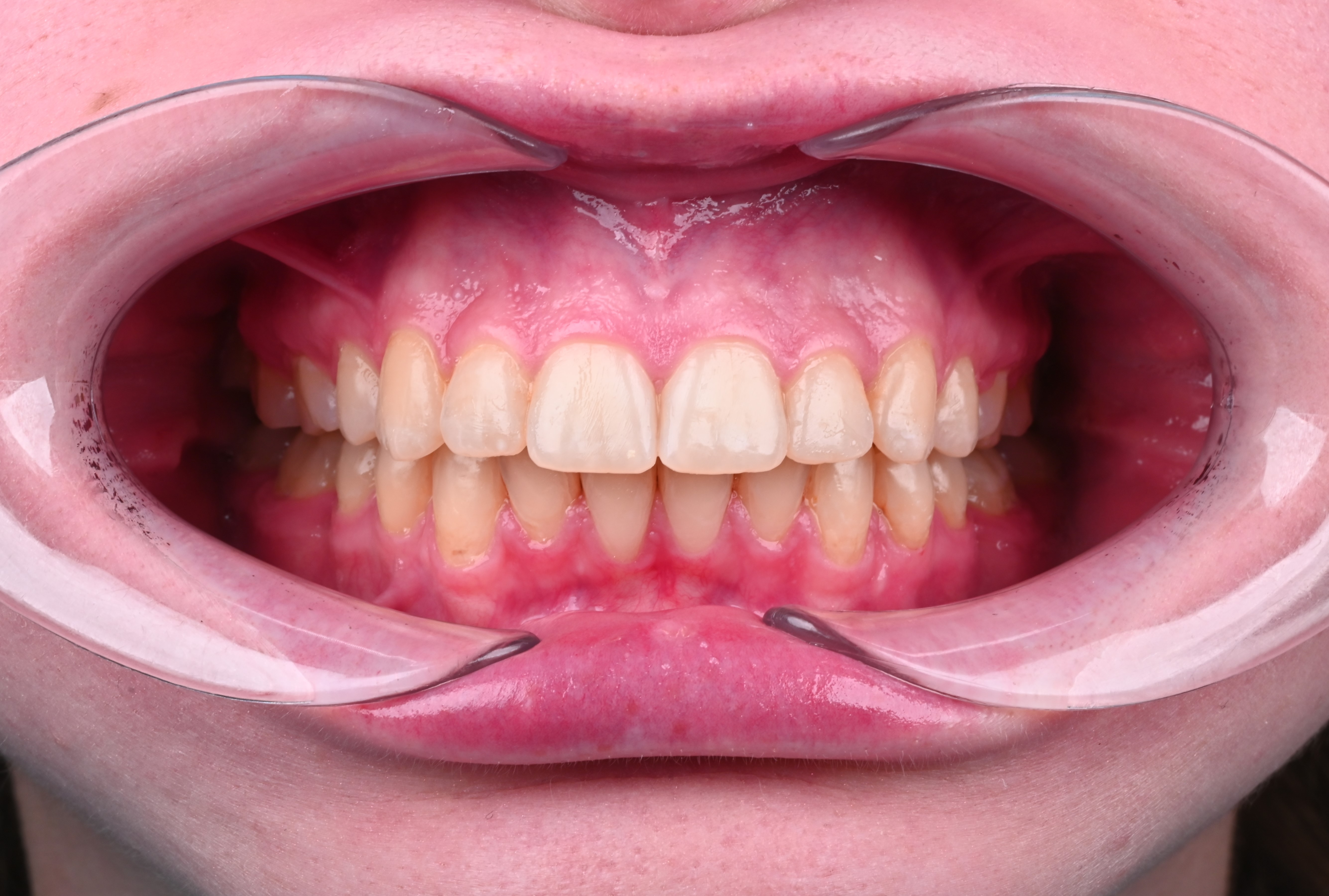 ЛЕЧЕНИЕ ПЕРЕКРЕСТНОГО ПРИКУСА, УСТРАНЕНИЕ СКУЧЕННОСТИ ЗУБОВ. 