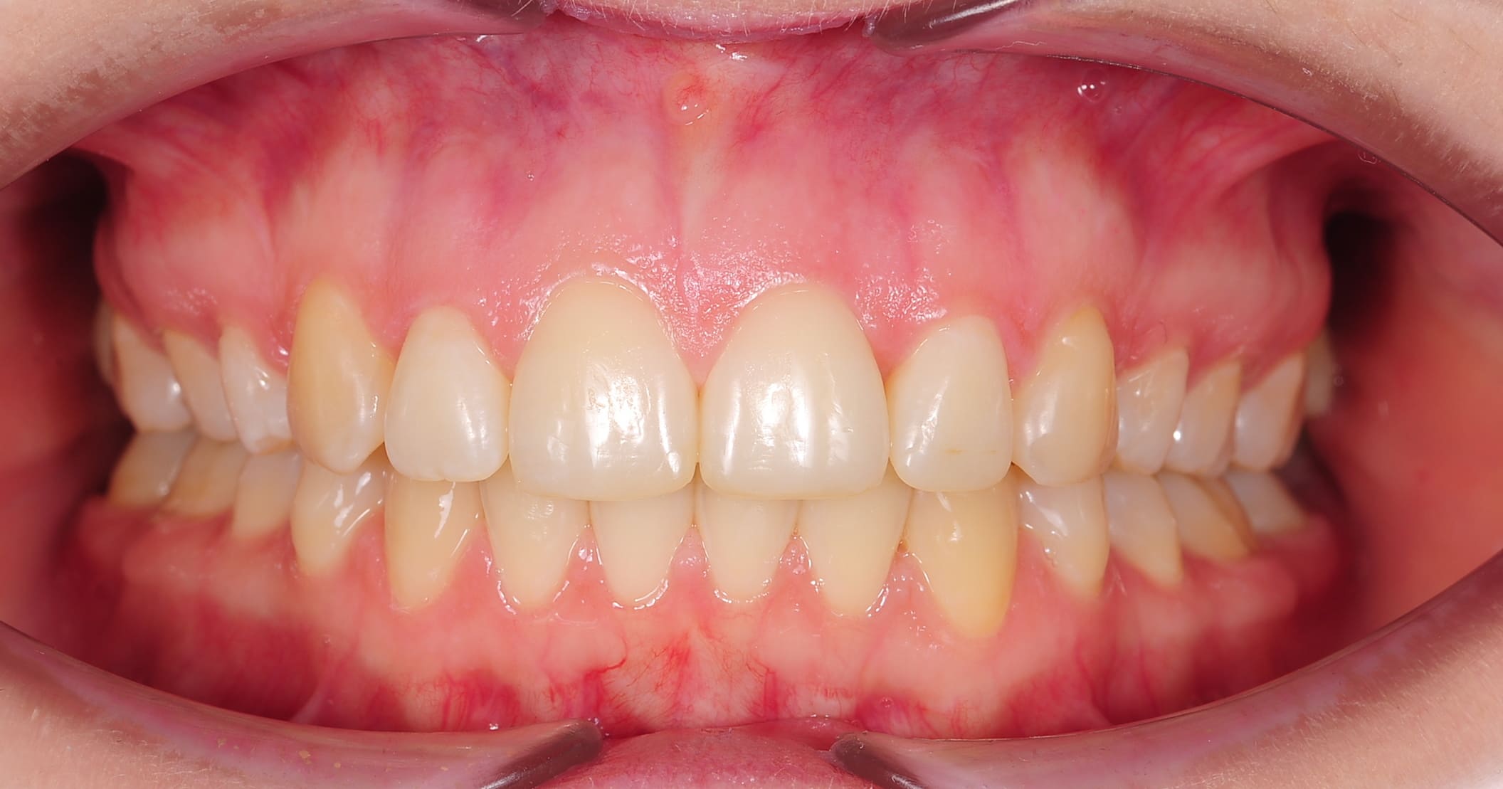 ЛЕЧЕНИЕ ПЕРЕКРЕСТНОГО ПРИКУСА, УСТРАНЕНИЕ СКУЧЕННОСТИ ЗУБОВ. 