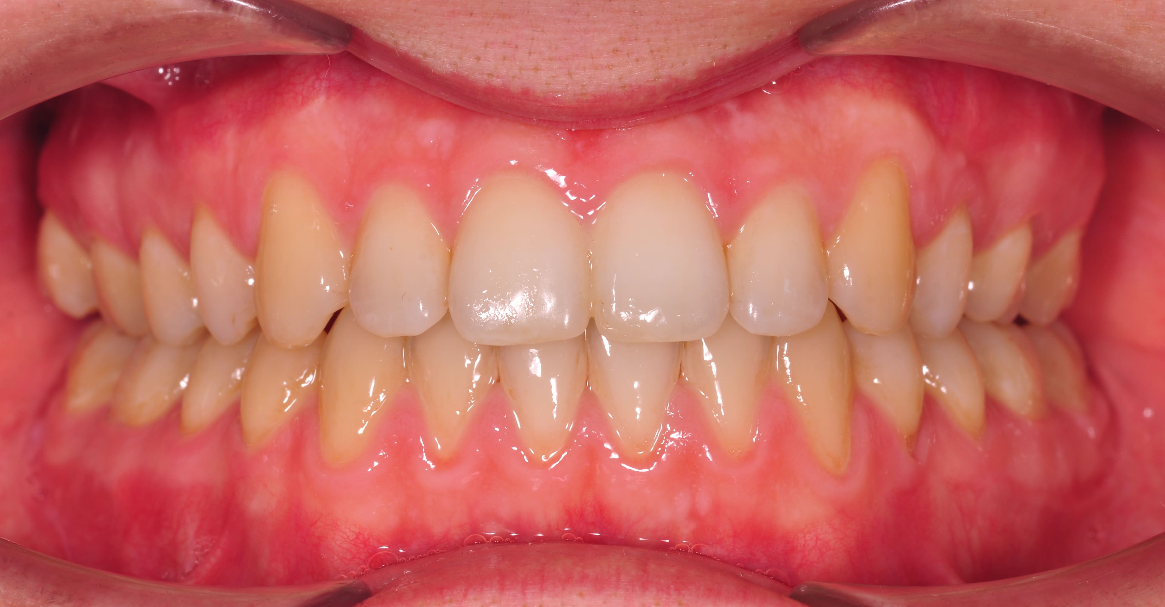 ЛЕЧЕНИЕ ПЕРЕКРЕСТНОГО ПРИКУСА, УСТРАНЕНИЕ СКУЧЕННОСТИ ЗУБОВ. 