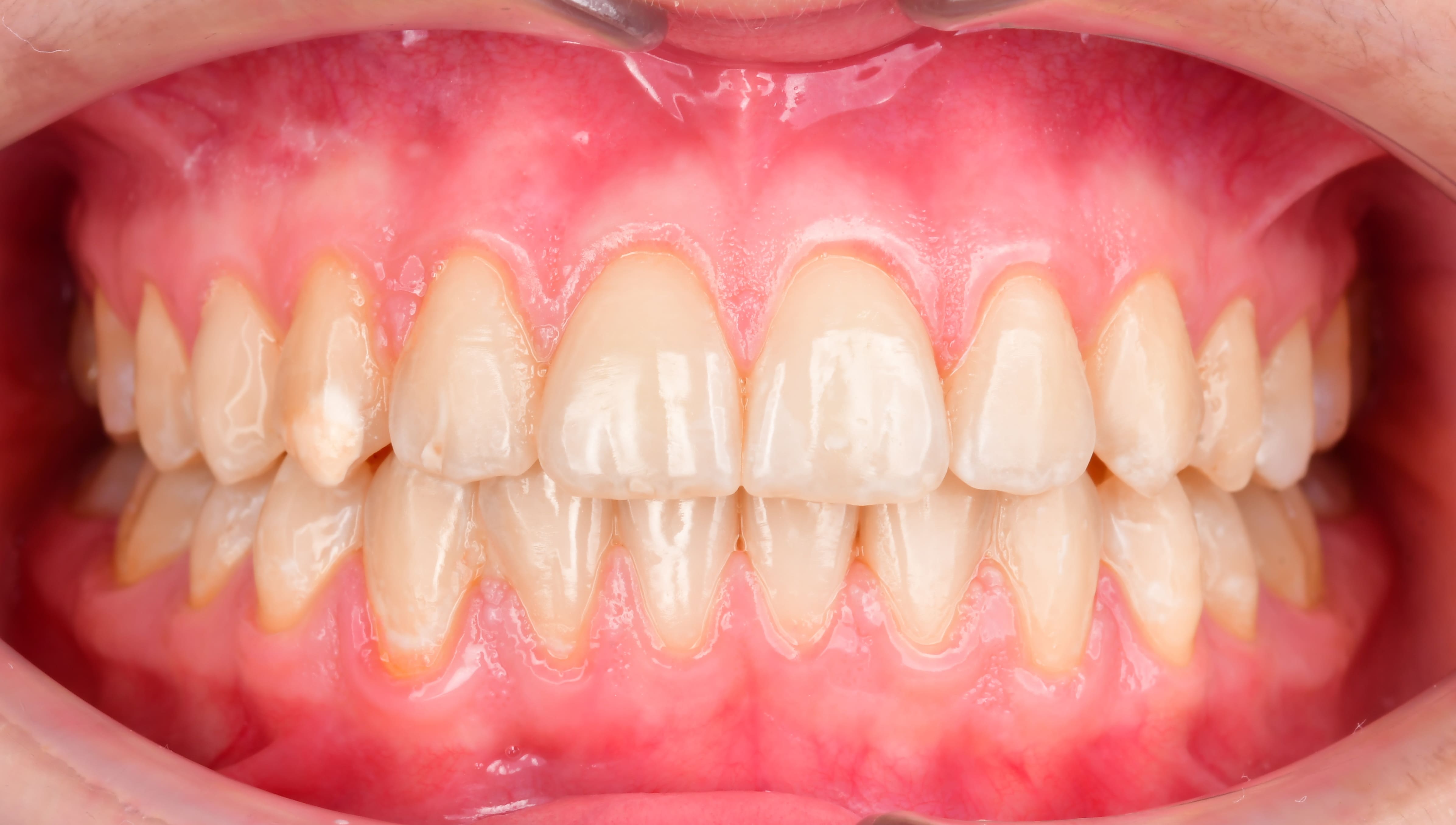 ЛЕЧЕНИЕ ПЕРЕКРЕСТНОГО ПРИКУСА, УСТРАНЕНИЕ СКУЧЕННОСТИ ЗУБОВ. 