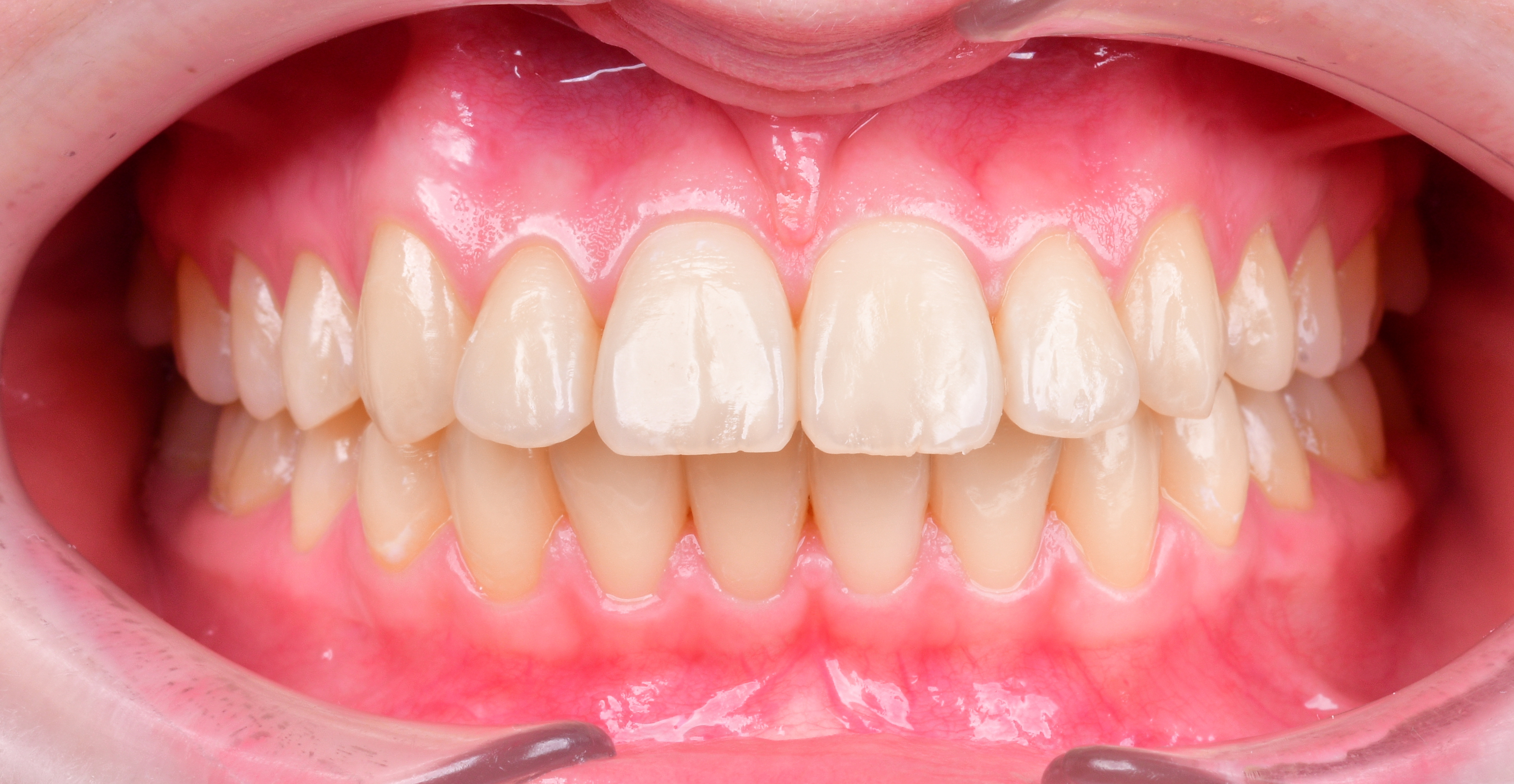 ЛЕЧЕНИЕ ПЕРЕКРЕСТНОГО ПРИКУСА, УСТРАНЕНИЕ СКУЧЕННОСТИ ЗУБОВ. 