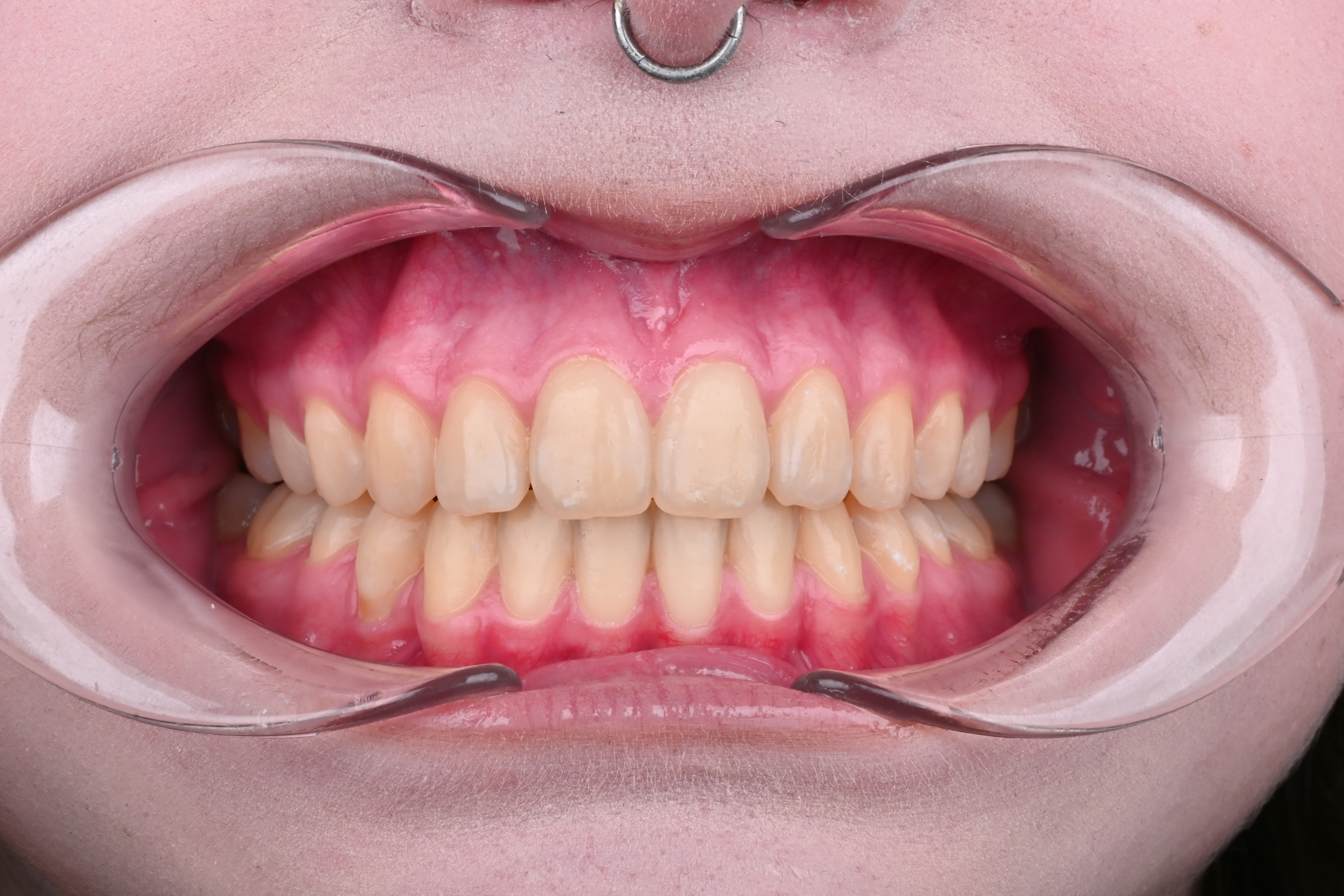 ЛЕЧЕНИЕ ПЕРЕКРЕСТНОГО ПРИКУСА, УСТРАНЕНИЕ СКУЧЕННОСТИ ЗУБОВ. 