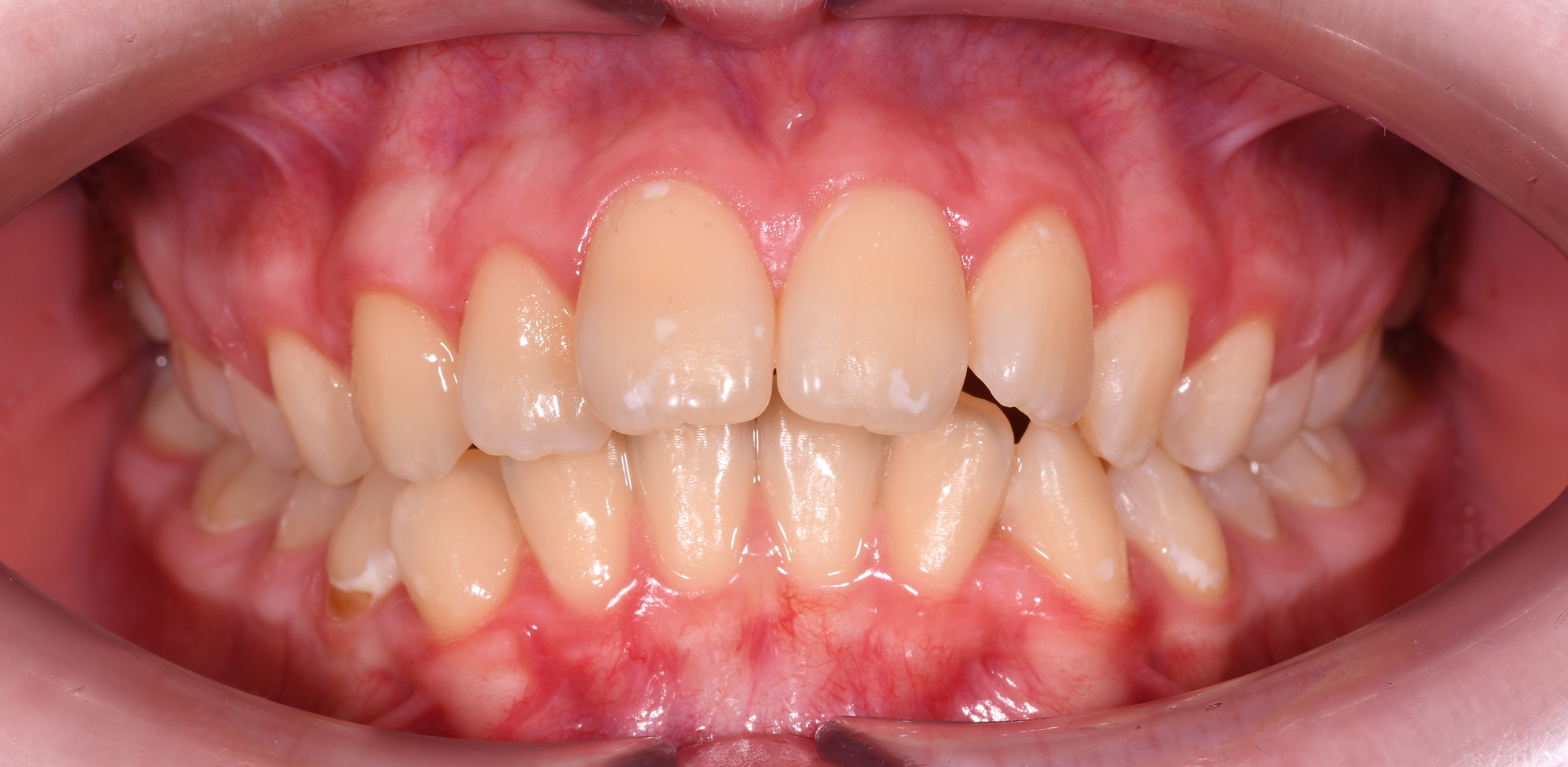 ЛЕЧЕНИЕ ПЕРЕКРЕСТНОГО ПРИКУСА, УСТРАНЕНИЕ СКУЧЕННОСТИ ЗУБОВ. 