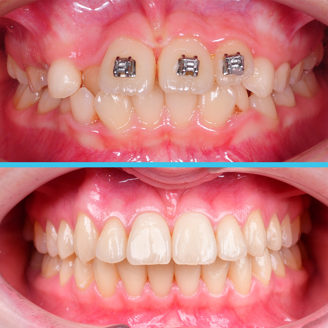 Лечение протрузии верхних резцов