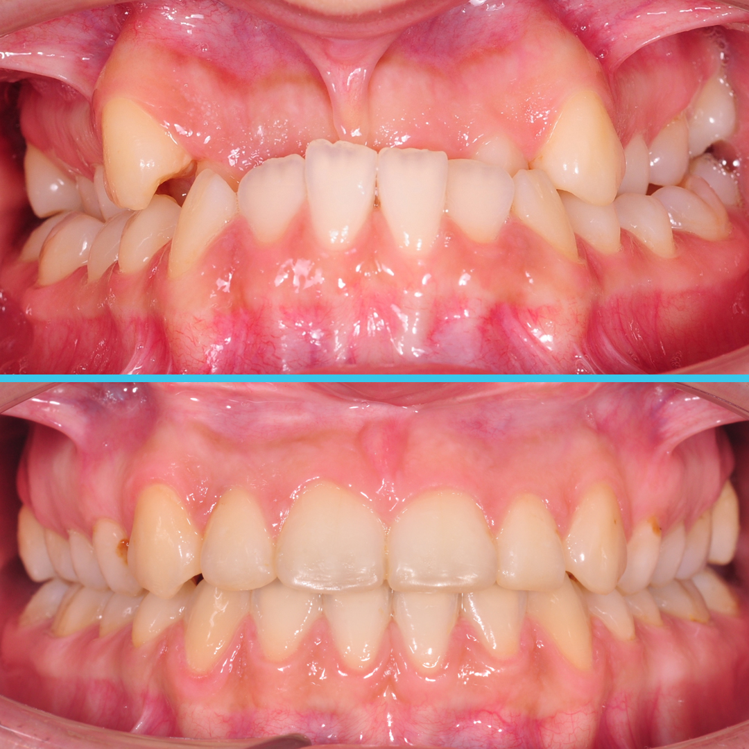 Лечение скелетного мезиального прикуса, сужение верхней челюсти