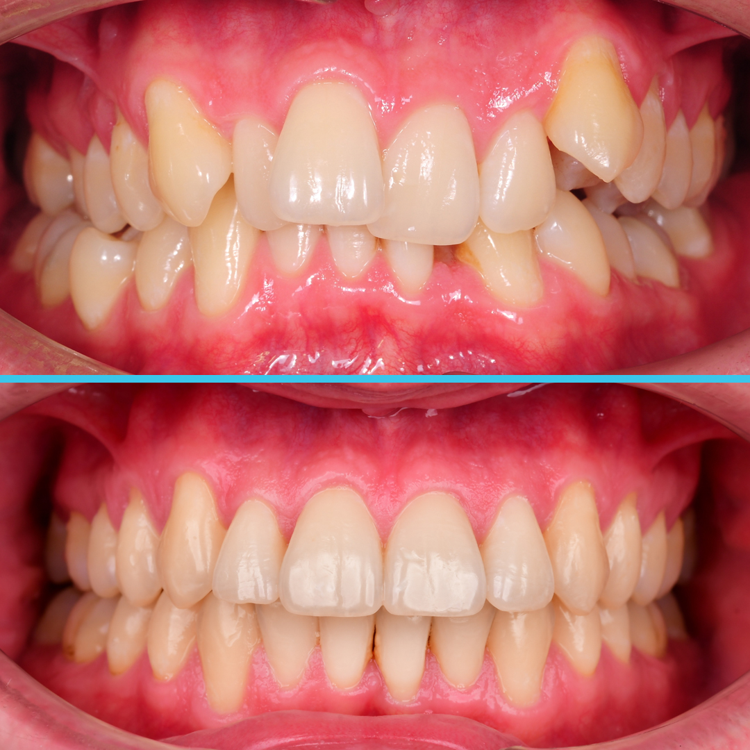 Лечение дистального прикуса у взрослого пациента, сильная скученность зубов