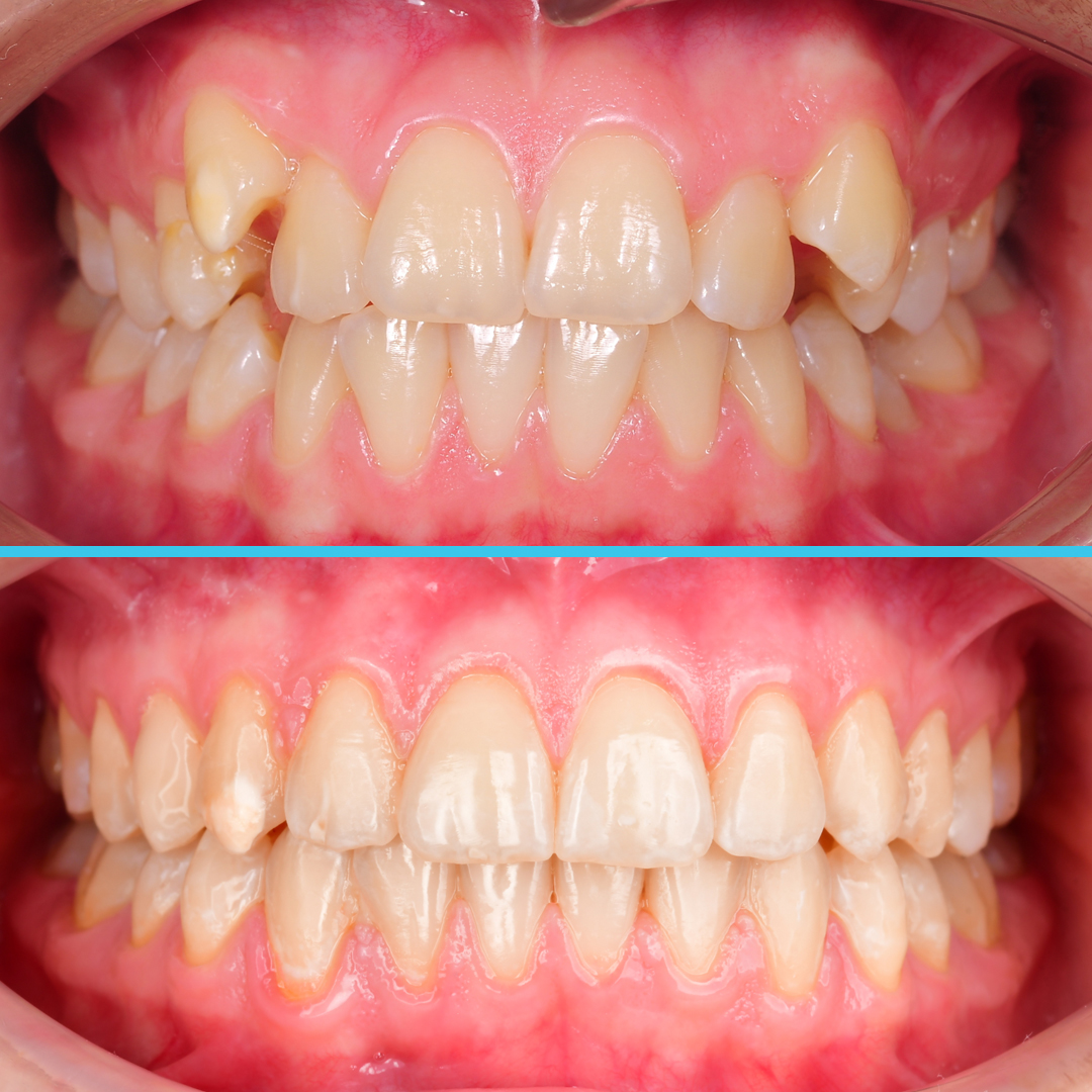 Лечение дистопии зубов клыков у подростка