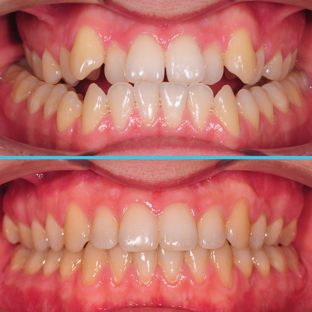 Лечение скелетного мезиального прикуса