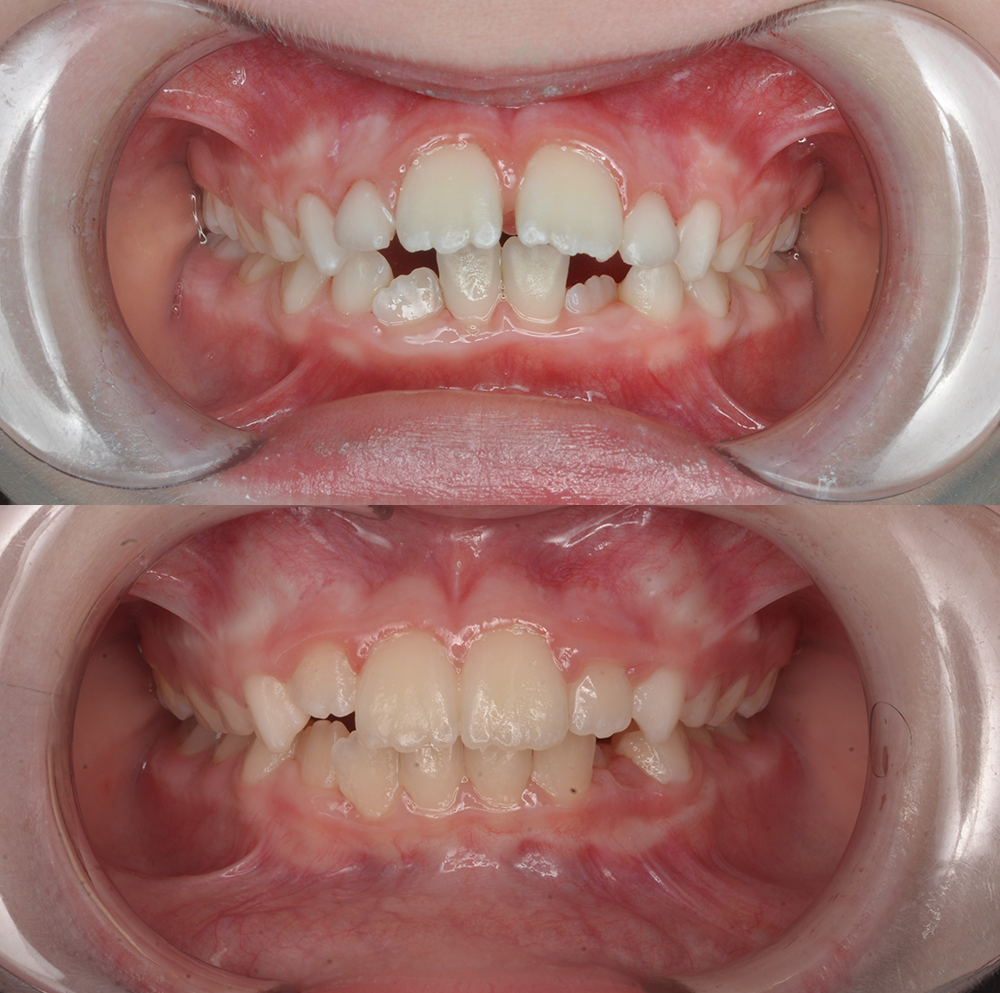 Коррекция открытого прикуса, закрепление результата