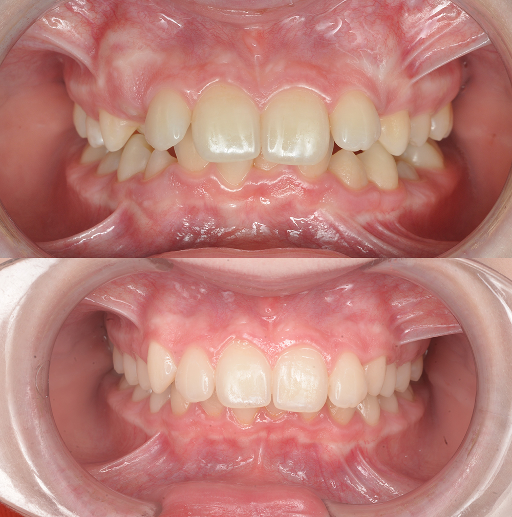 Произведено расширение верхней челюсти, создание места для 23 зуба