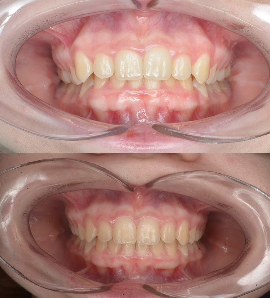Произведена коррекция глубокого, дистального прикуса