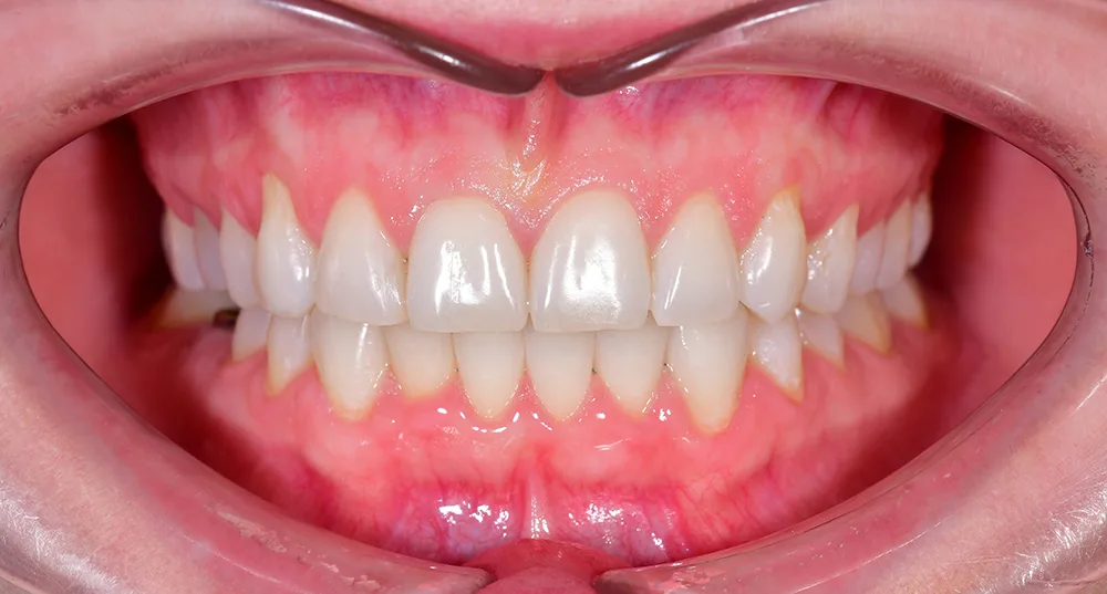 Выравнивание нижних зубов, после лечения